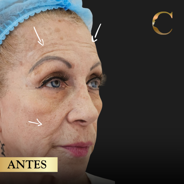 Bioestimuladores de colágeno 1