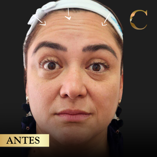 Bótox antes 1
