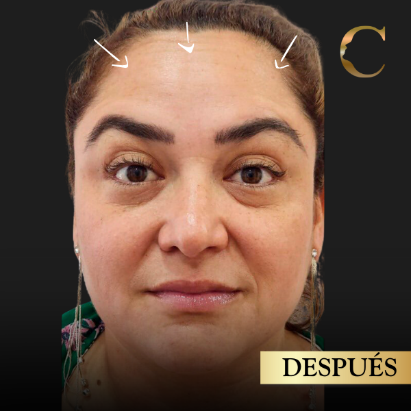 Bótox después 1