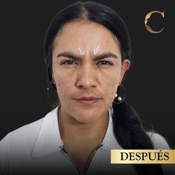Fullface después 2